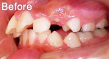 上顎前突（出っ歯）非抜歯1