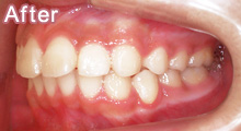 上顎前突（出っ歯）非抜歯2