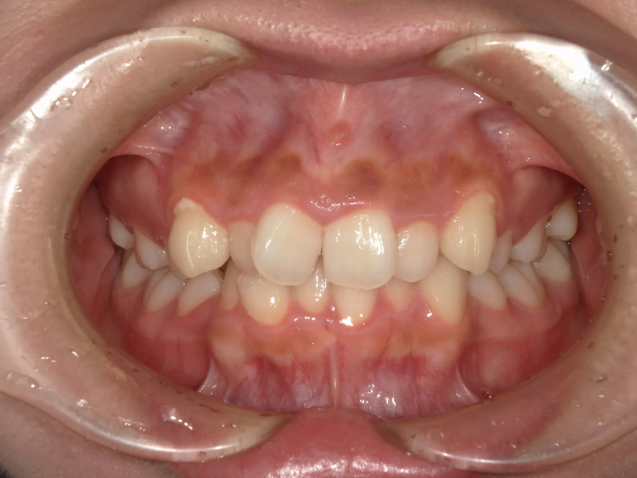 天王寺矯正歯科クリニック 歯科矯正の施術前写真