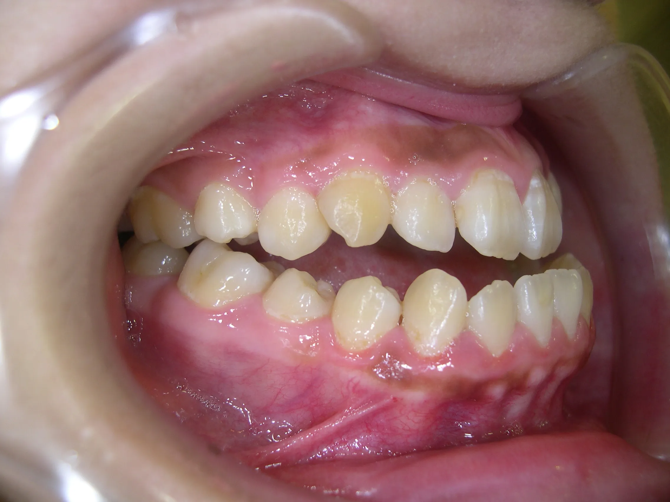 天王寺矯正歯科クリニック 歯科矯正の施術前写真