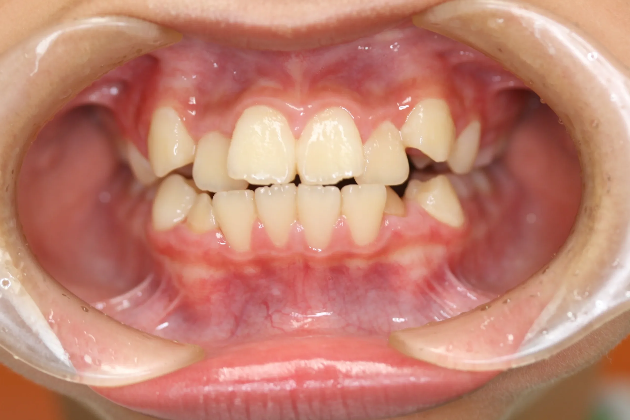 天王寺矯正歯科クリニック 歯科矯正の施術前写真