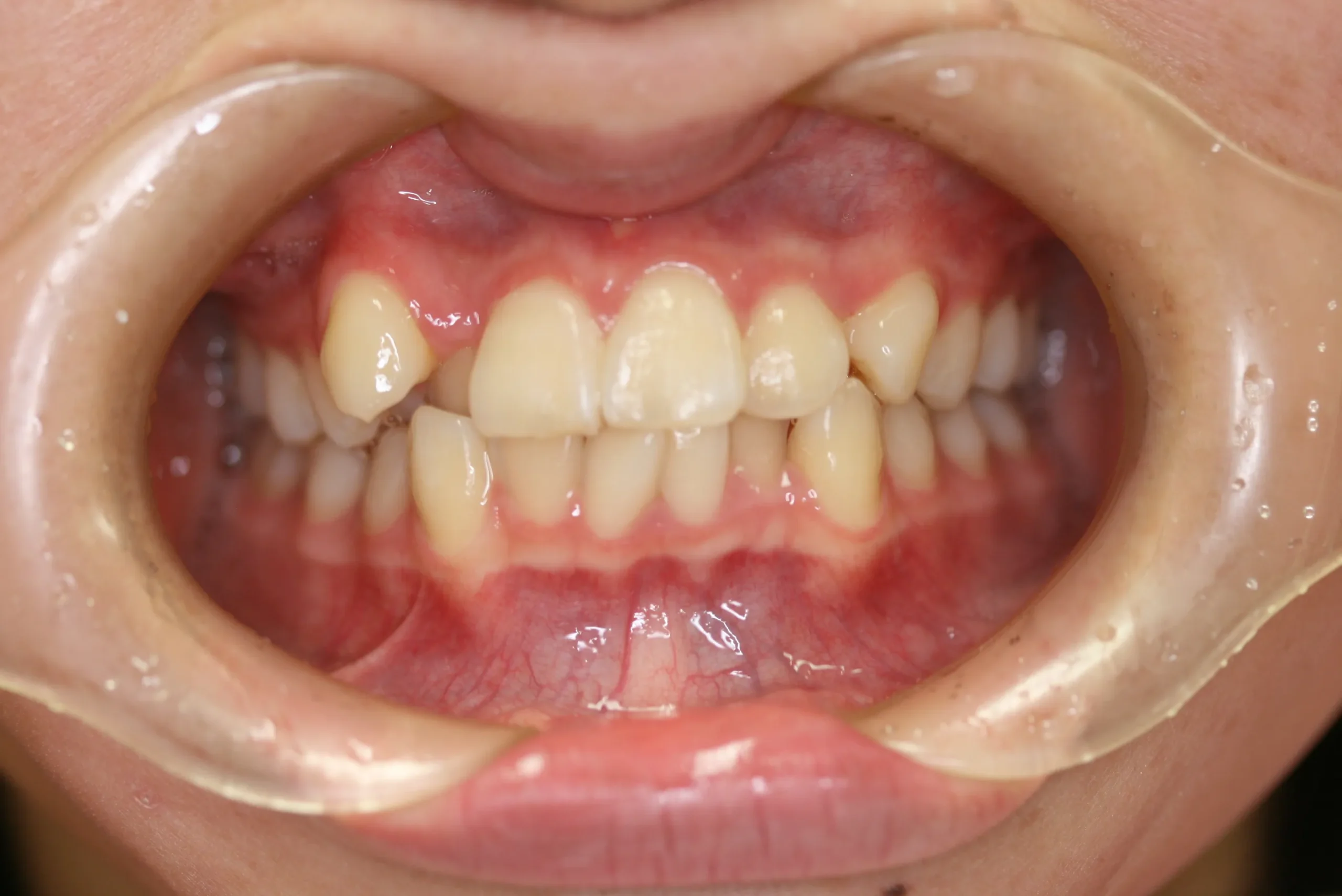 天王寺矯正歯科クリニック 歯科矯正の施術前写真