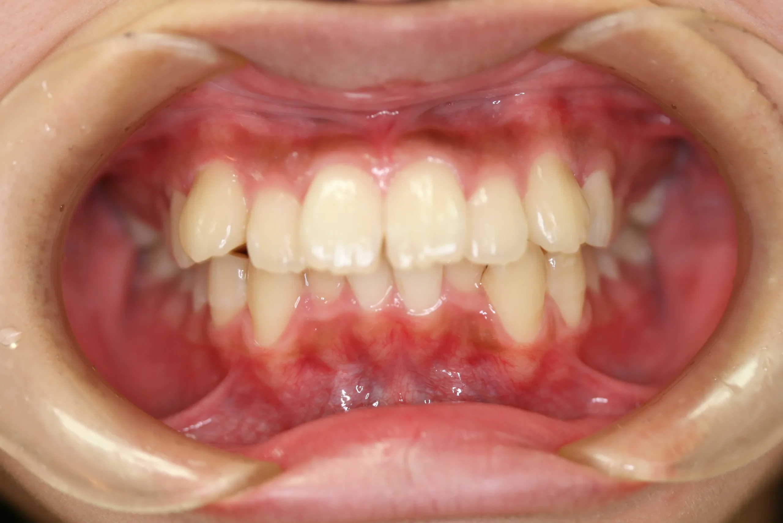 天王寺矯正歯科クリニック 歯科矯正の施術前写真