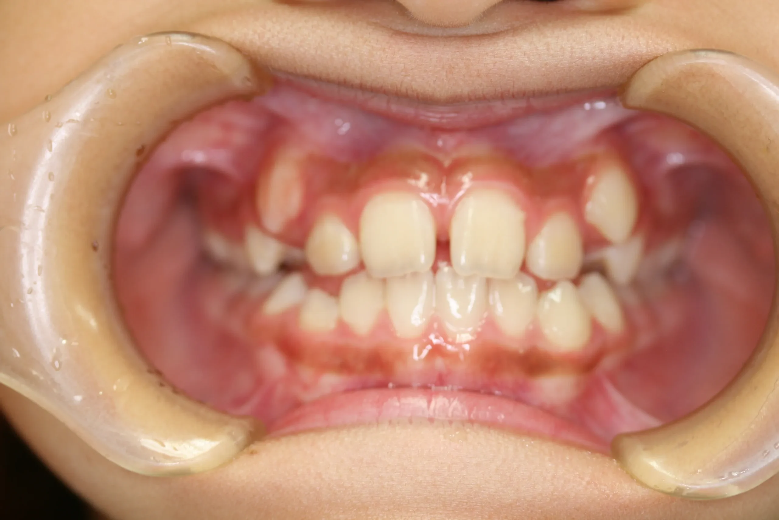 天王寺矯正歯科クリニック 歯科矯正の施術前写真