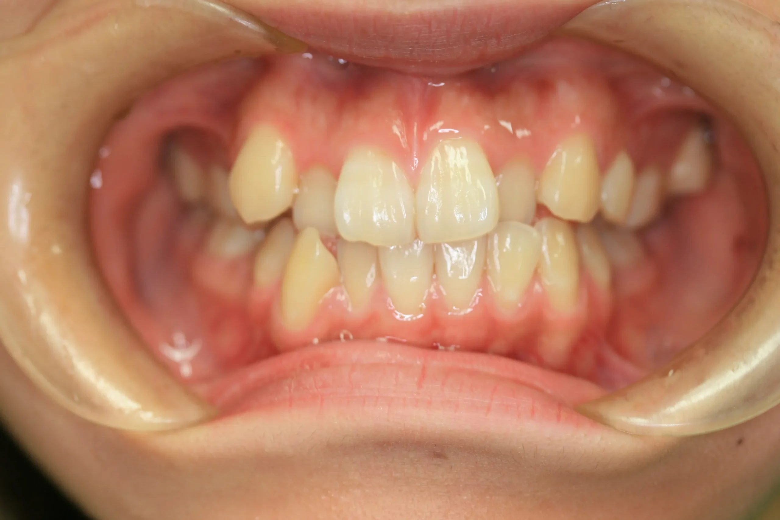 天王寺矯正歯科クリニック 歯科矯正の施術前写真