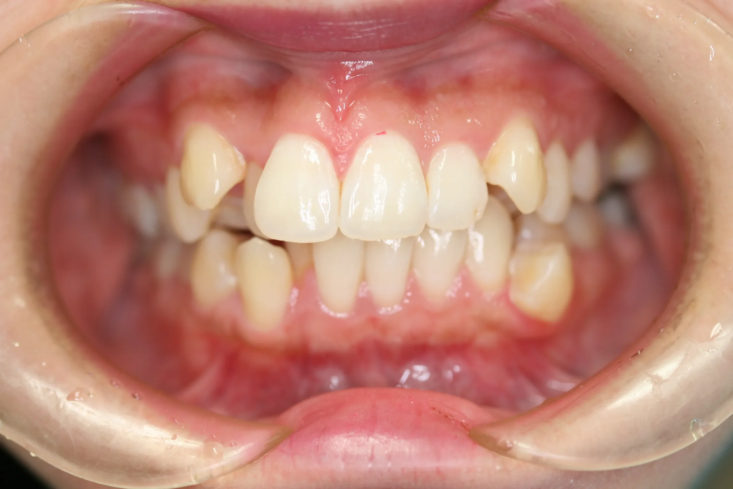 天王寺矯正歯科クリニック 歯科矯正の施術前写真