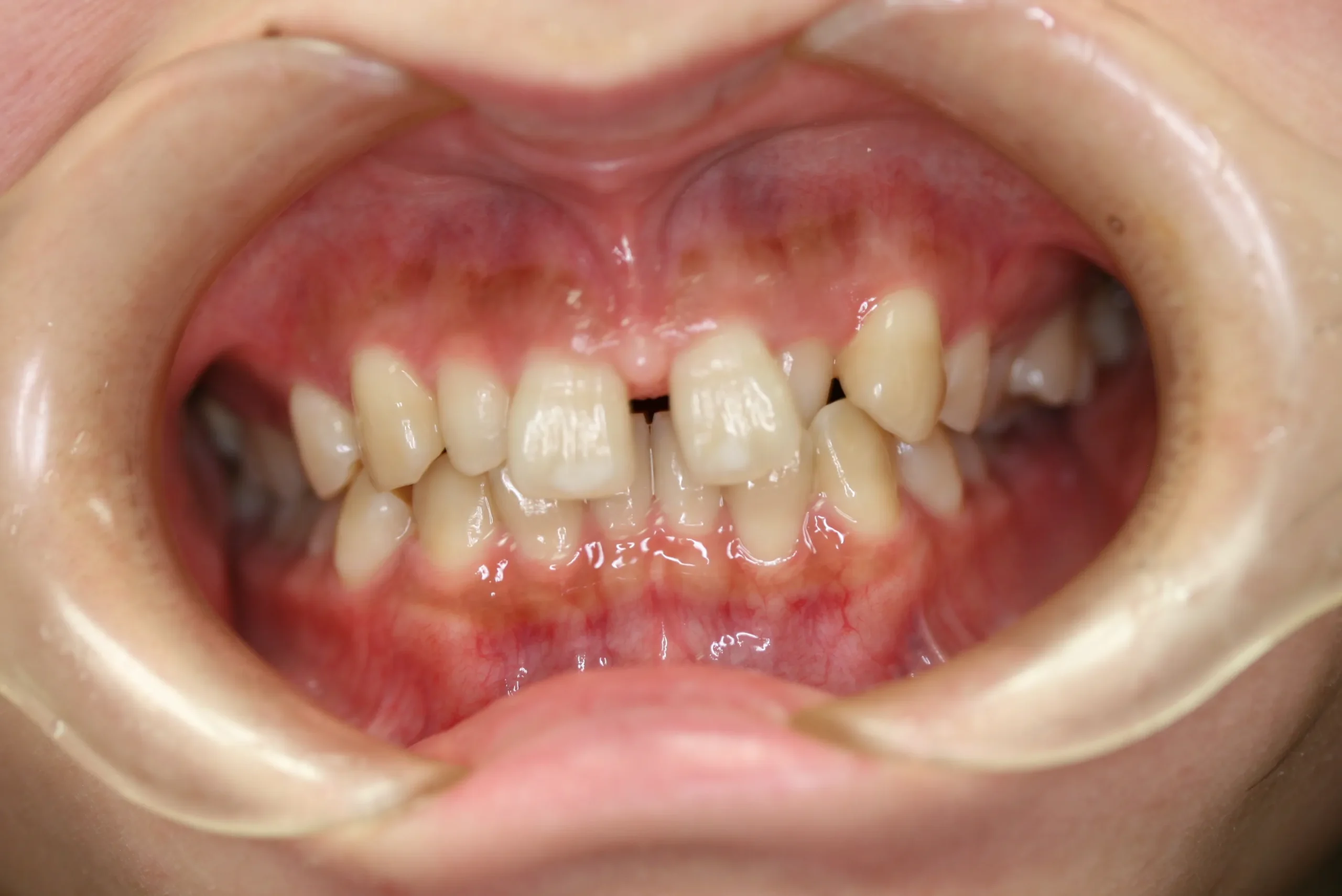 天王寺矯正歯科クリニック 歯科矯正の施術前写真