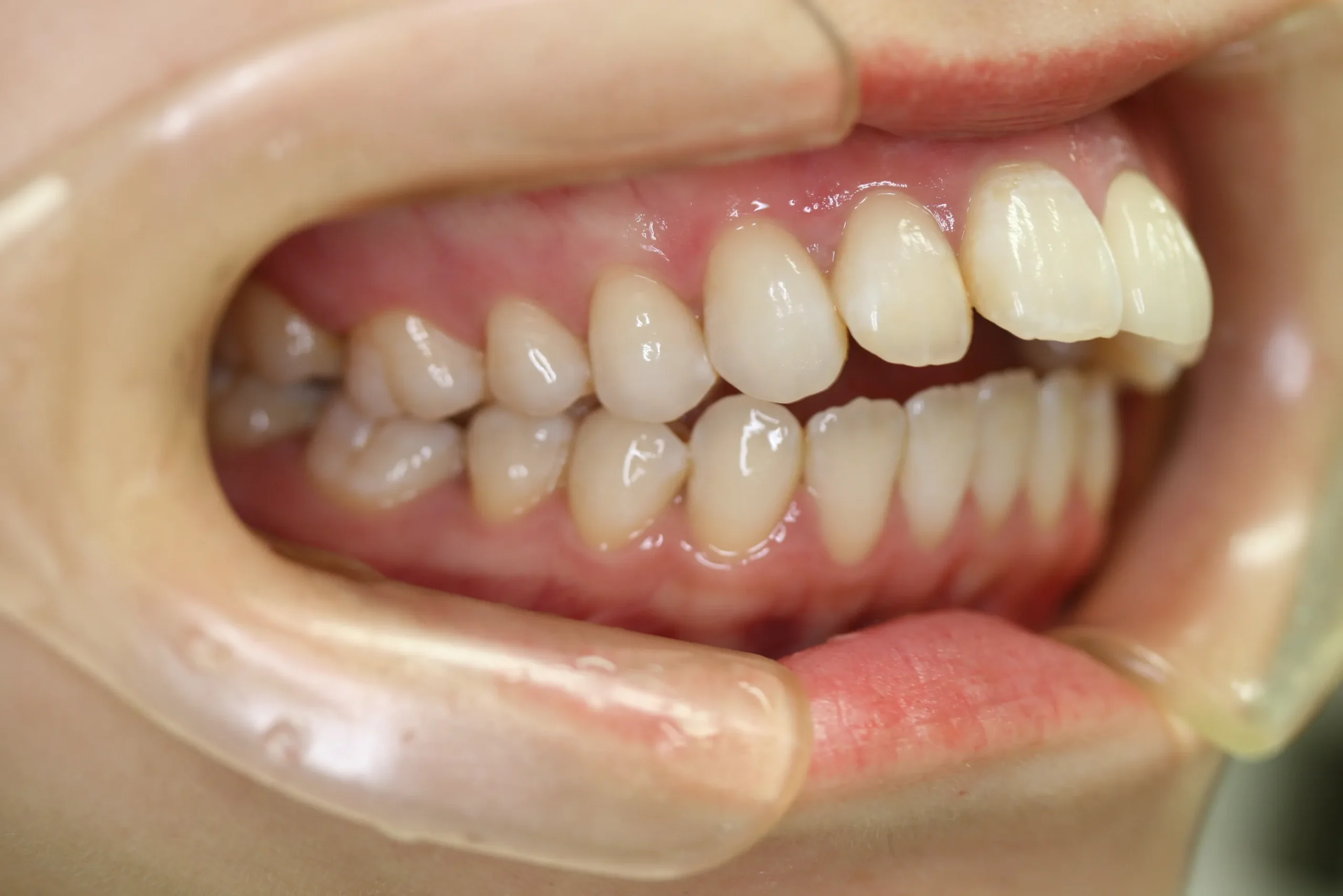 天王寺矯正歯科クリニック 歯科矯正の施術前写真