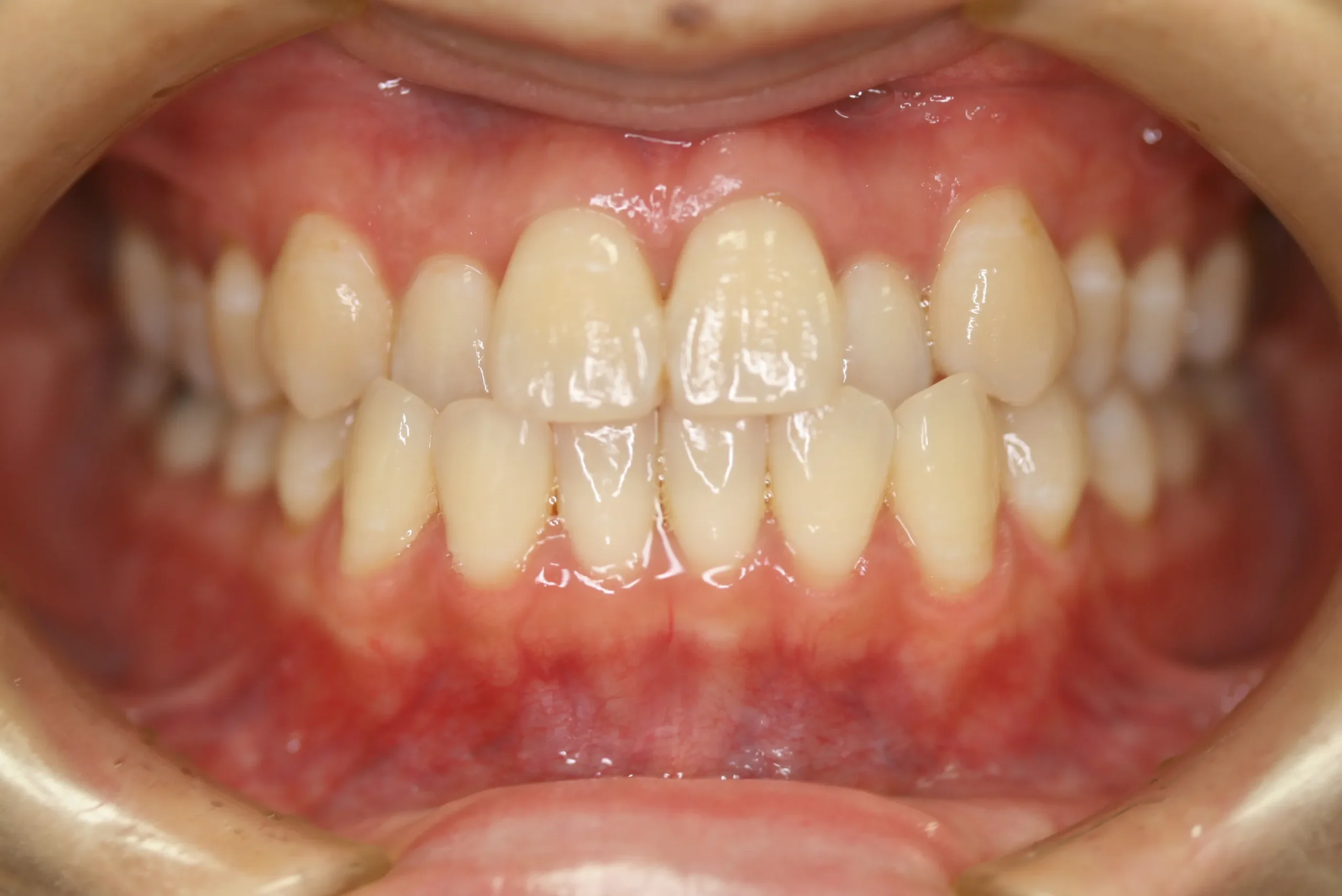 天王寺矯正歯科クリニック 歯科矯正の施術前写真