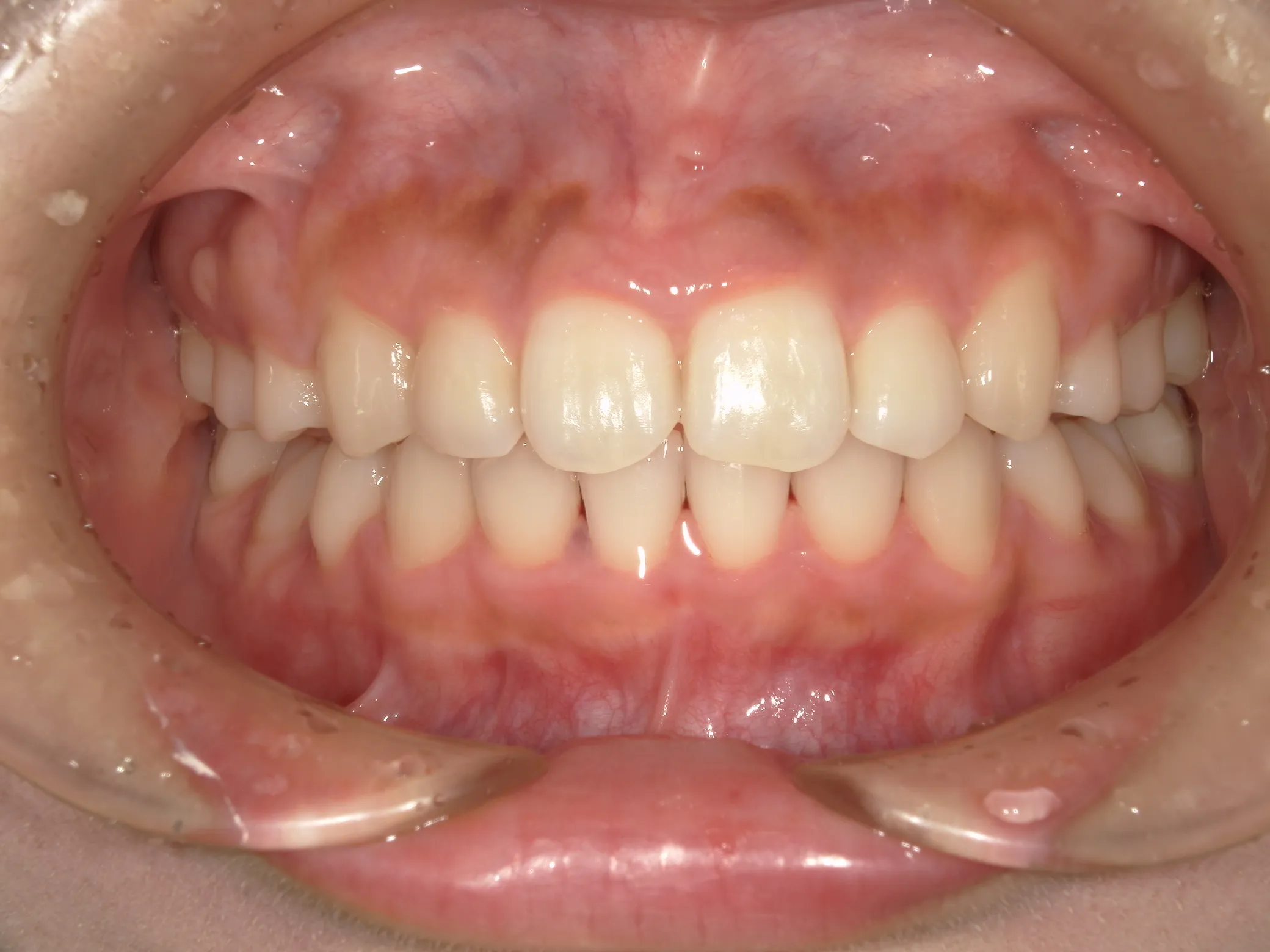 天王寺矯正歯科クリニック 歯科矯正の症例写真