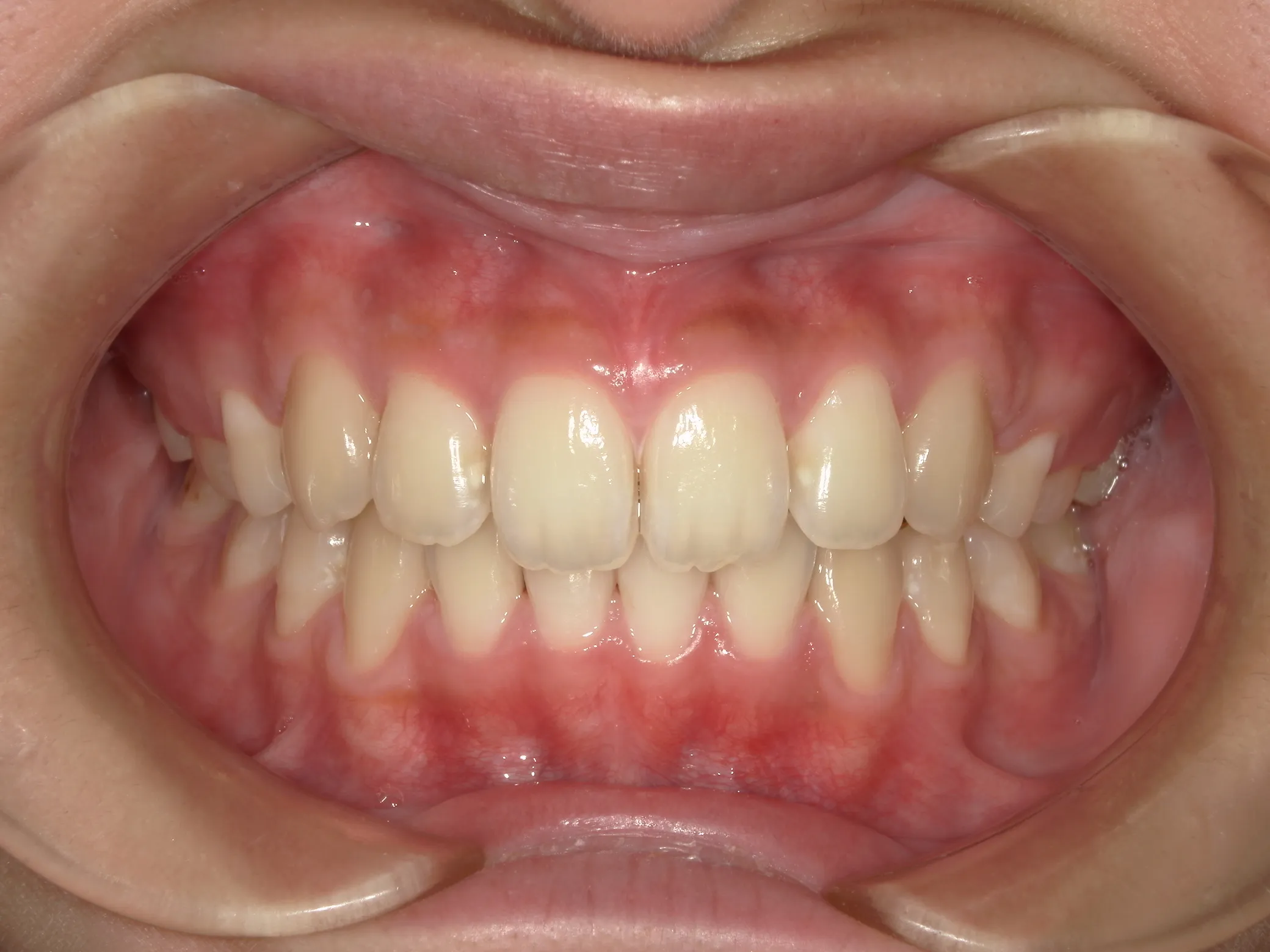 天王寺矯正歯科クリニック 歯科矯正の症例写真