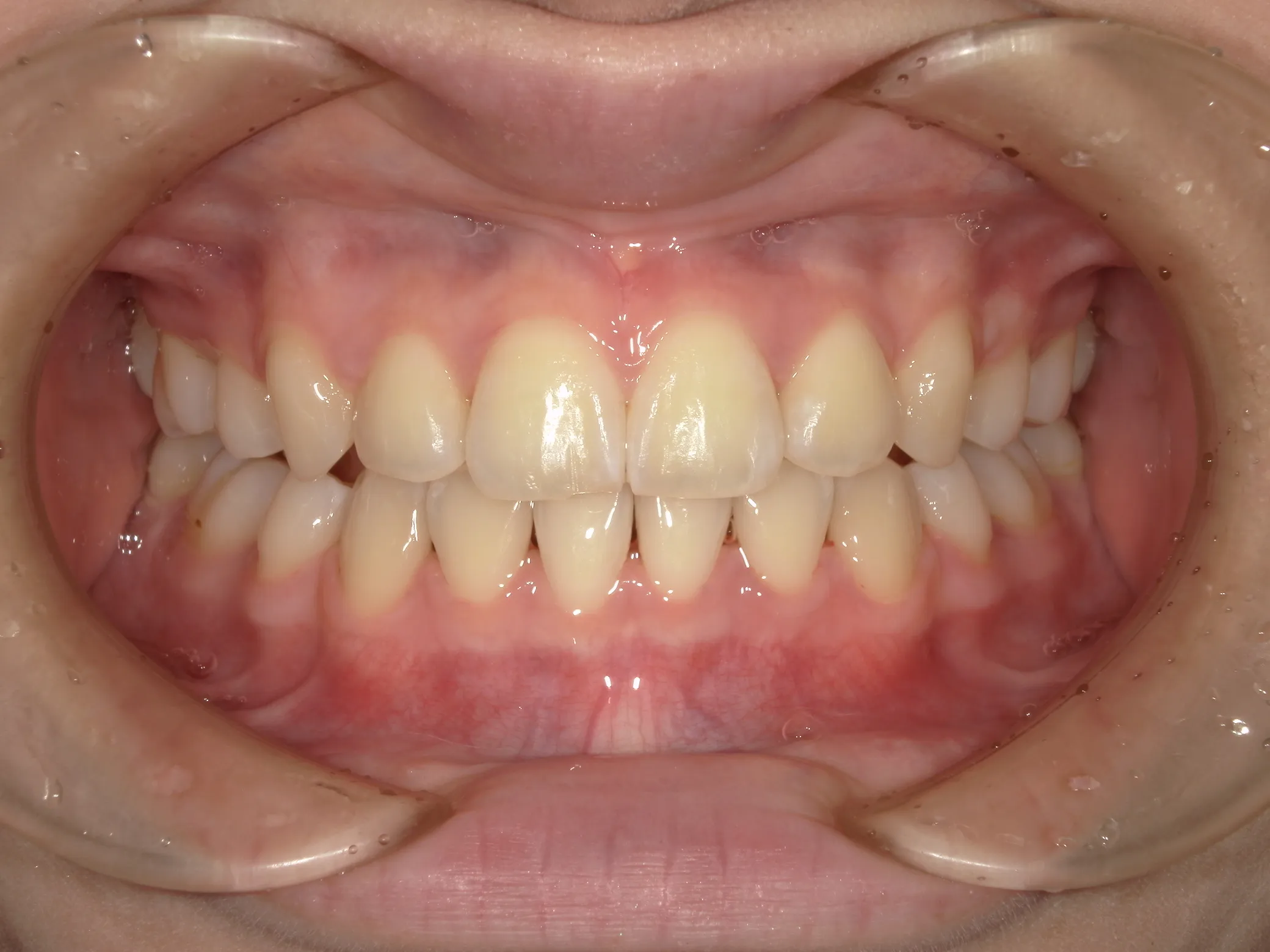 天王寺矯正歯科クリニック 歯科矯正の症例写真