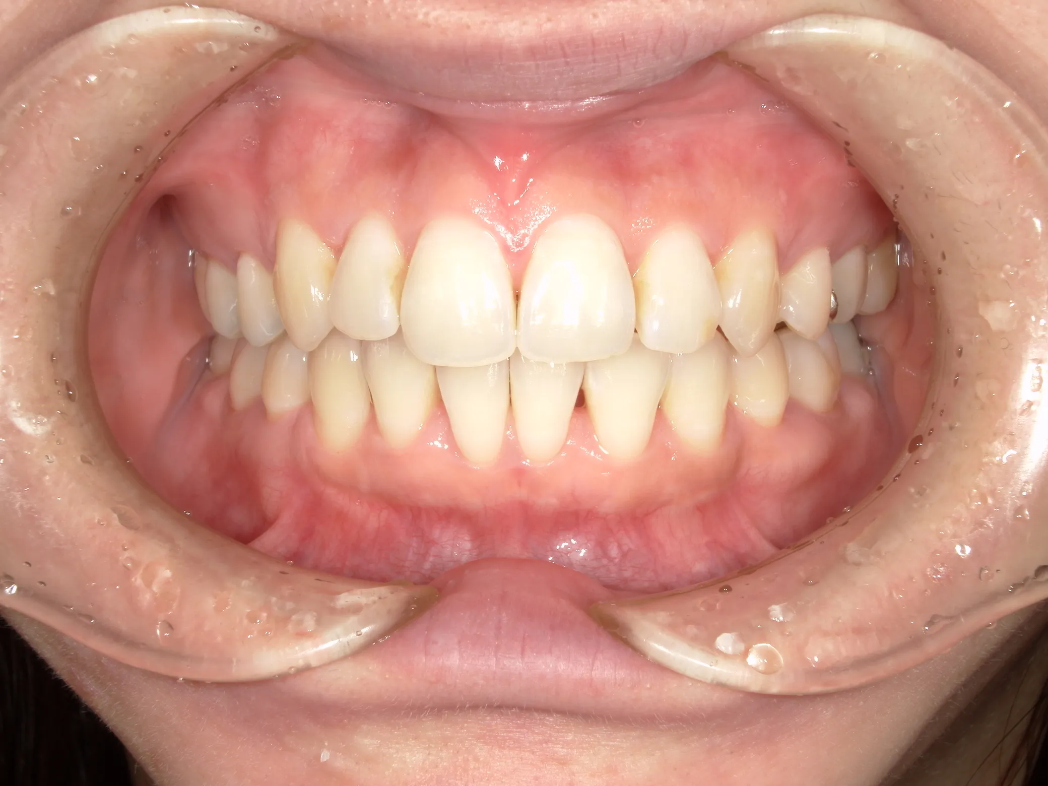 天王寺矯正歯科クリニック 歯科矯正の症例写真