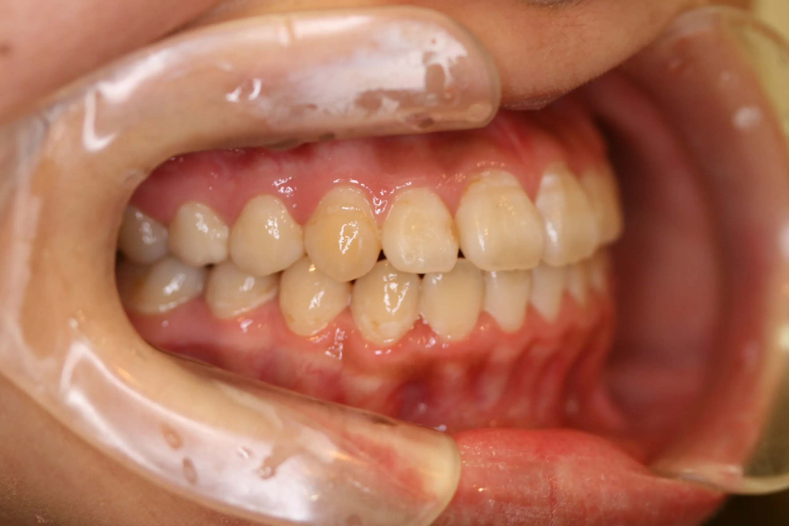 天王寺矯正歯科クリニック 歯科矯正の症例写真