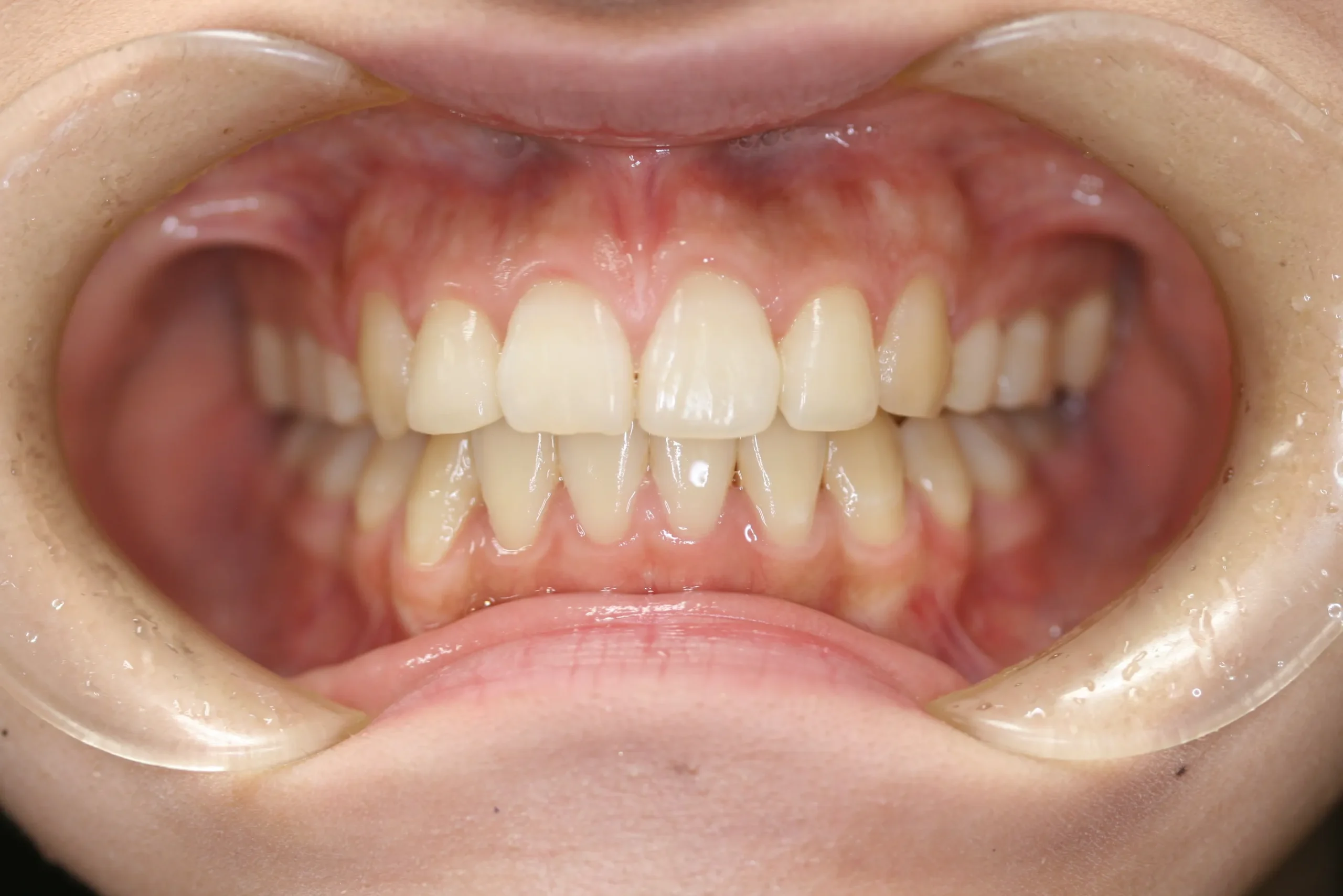 天王寺矯正歯科クリニック 歯科矯正の症例写真