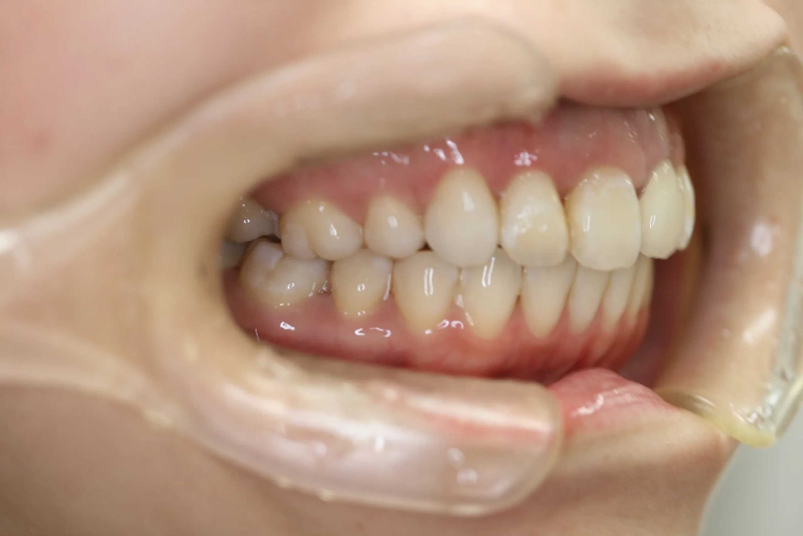 天王寺矯正歯科クリニック 歯科矯正の症例写真