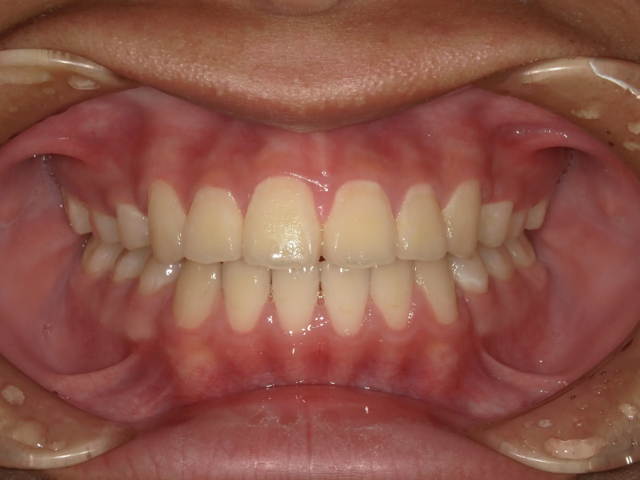 天王寺矯正歯科クリニック 歯科矯正の症例写真