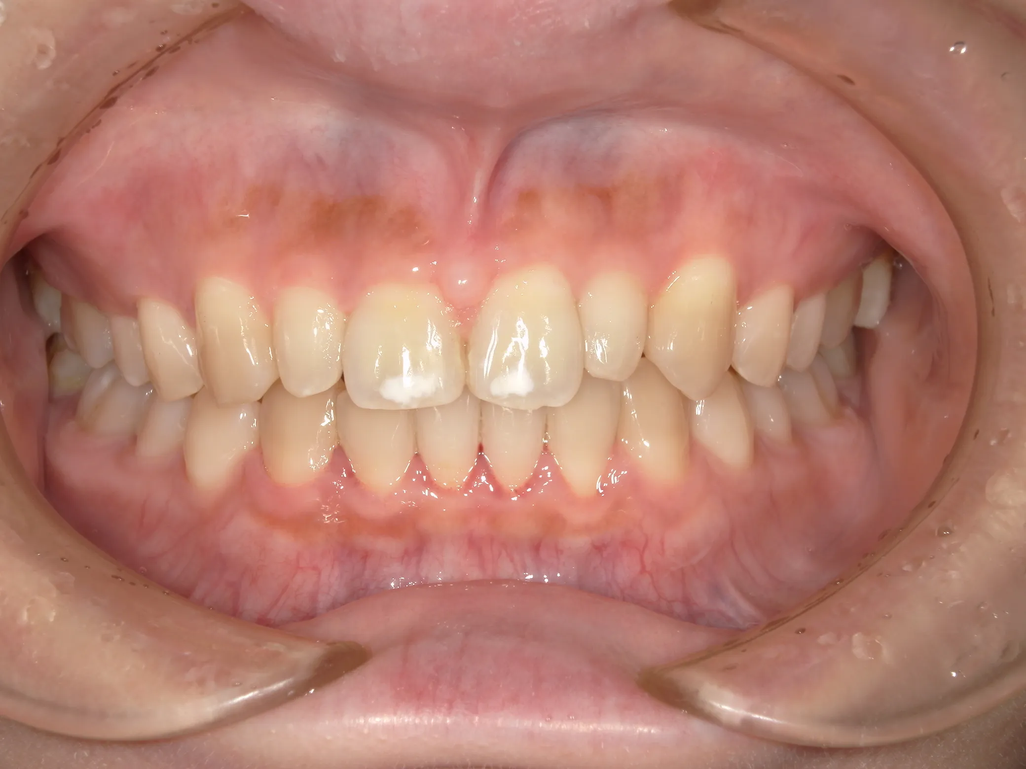 天王寺矯正歯科クリニック 歯科矯正の症例写真