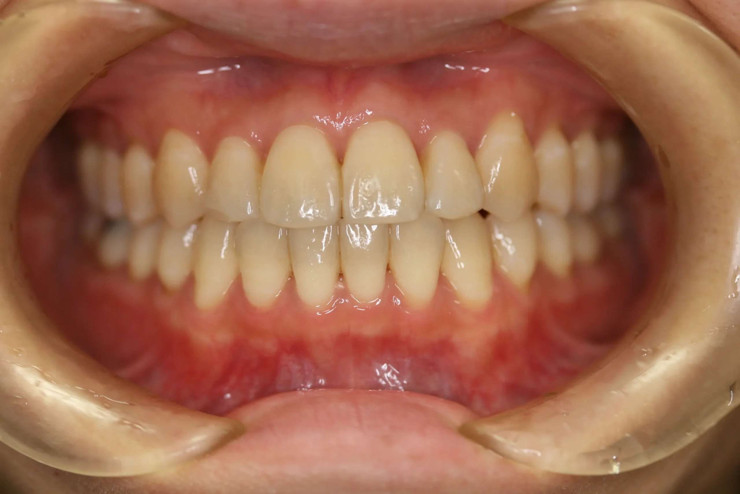 天王寺矯正歯科クリニック 歯科矯正の症例写真