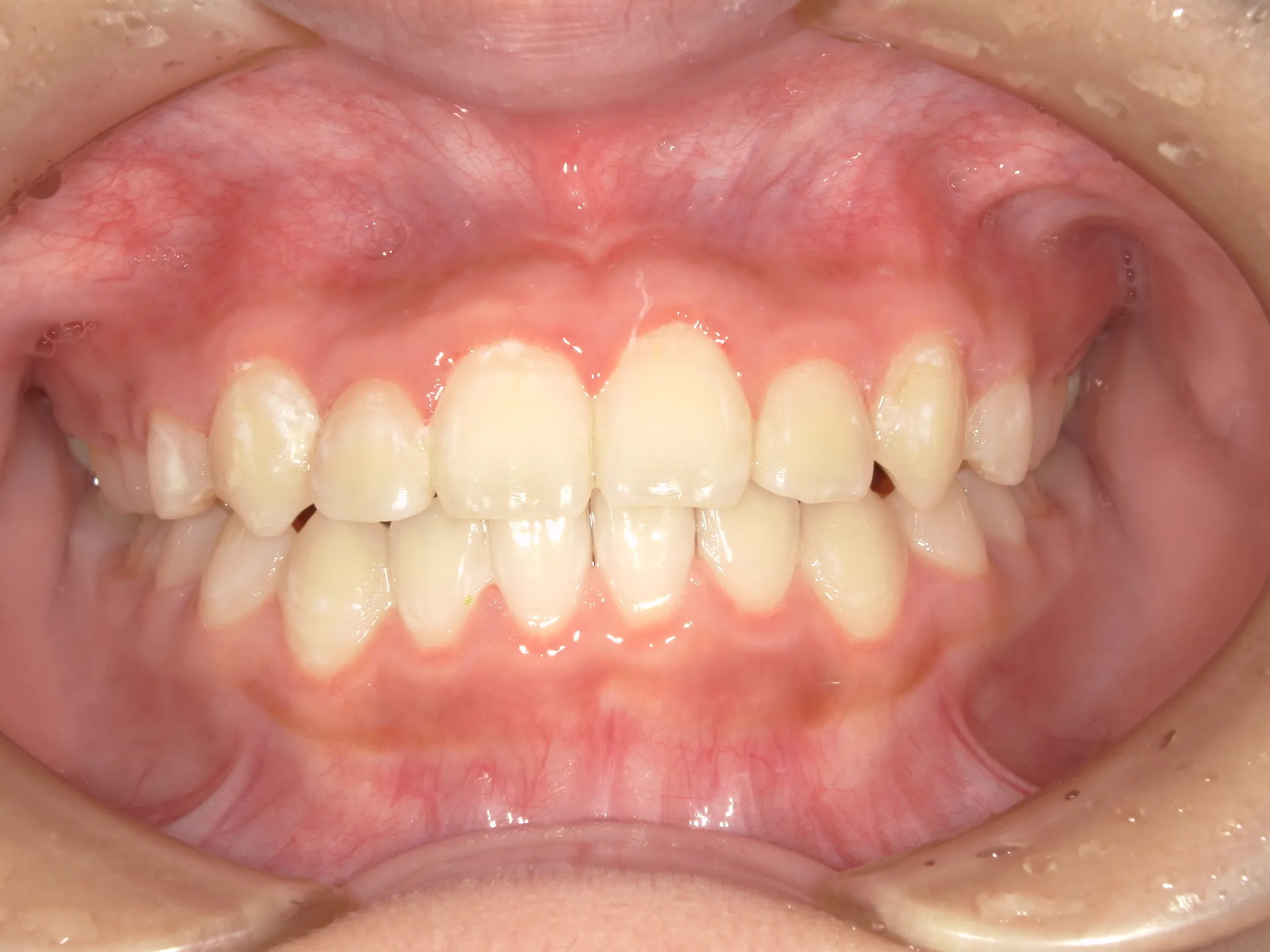 天王寺矯正歯科クリニック 歯科矯正の症例写真